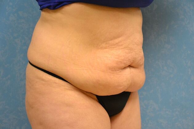 Tummy Tuck: Case 1799- Toledo, OH - Before