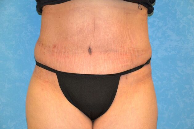 Tummy Tuck Case 1799- Toledo, OH - After