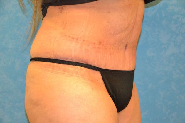 Tummy Tuck: Case 1799- Toledo, OH - After