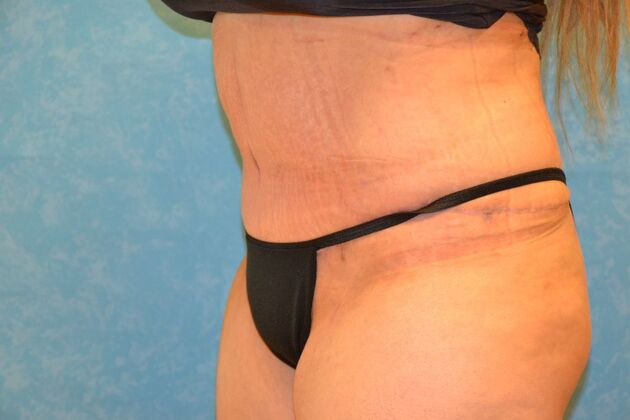 Tummy Tuck: Case 1799- Toledo, OH - After