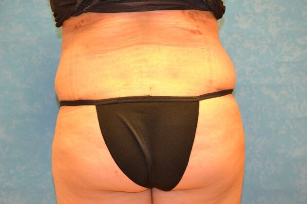 Tummy Tuck: Case 1799- Toledo, OH - After