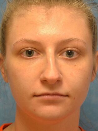 Rhinoplasty Case 1725- Temperance, MI - Before