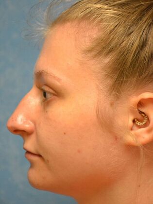 Rhinoplasty: Case 1725- Temperance, MI - Before