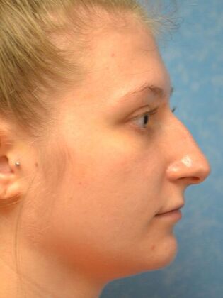 Rhinoplasty: Case 1725- Temperance, MI - Before