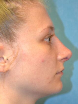 Rhinoplasty: Case 1725- Temperance, MI - After