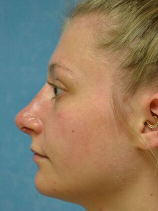 Rhinoplasty: Case 1725- Temperance, MI - After