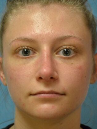 Rhinoplasty Case 1725- Temperance, MI - After