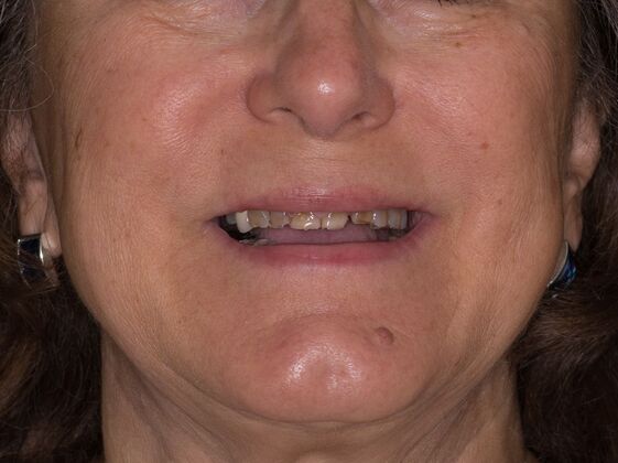 Full Mouth Rehabilitation BC - Before