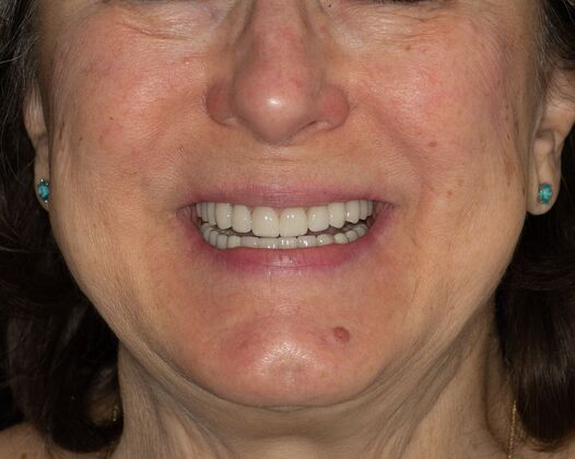 Full Mouth Rehabilitation BC - After
