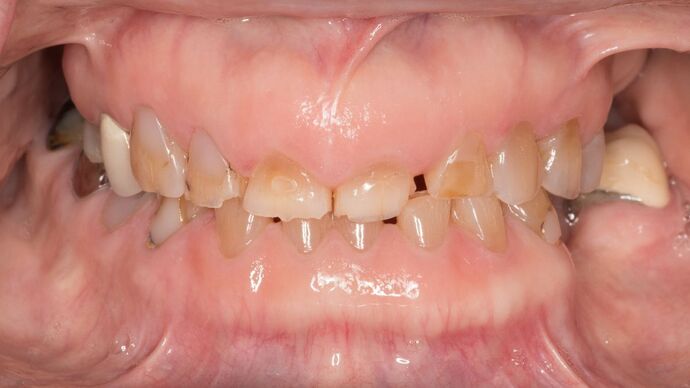 Full Mouth Rehabilitation: BC - Before
