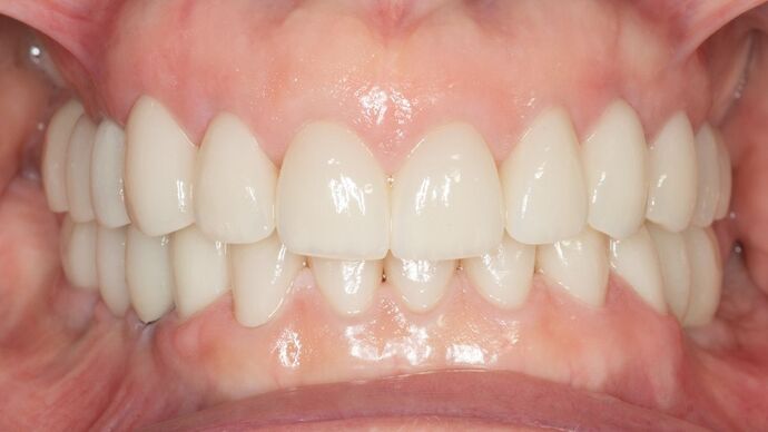 Full Mouth Rehabilitation: BC - After