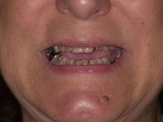 Full Mouth Rehabilitation: BC - Before