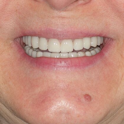 Full Mouth Rehabilitation: BC - After