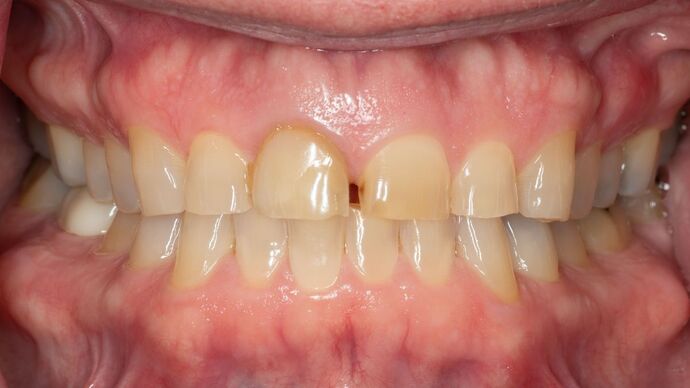 Full Mouth Rehabilitation JD - Before