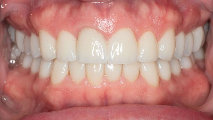 Full Mouth Rehabilitation JD - After