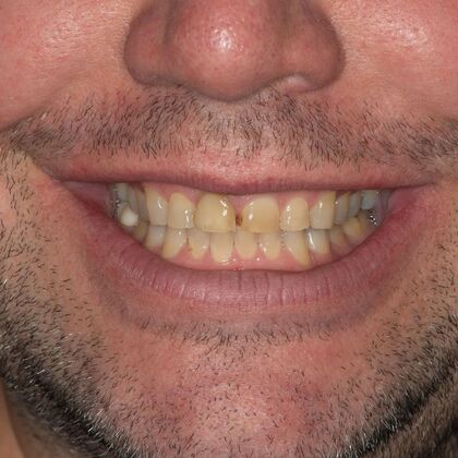 Full Mouth Rehabilitation: JD - Before