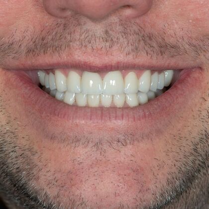 Full Mouth Rehabilitation: JD - After