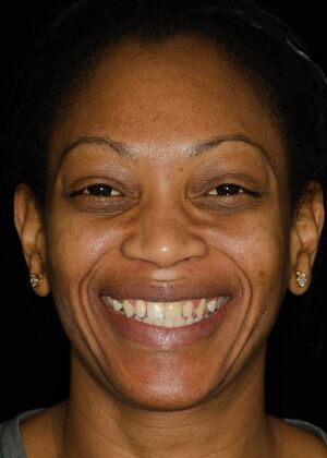 Porcelain Veneers: AB - Before