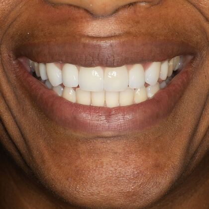 Porcelain Veneers: AB - After