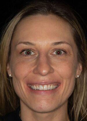 Porcelain Veneers: GJ - Before