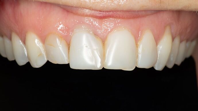 Porcelain Veneers: GJ - Before