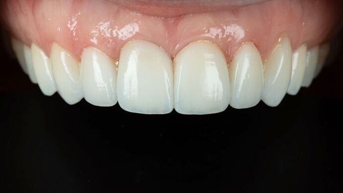Porcelain Veneers: GJ - After