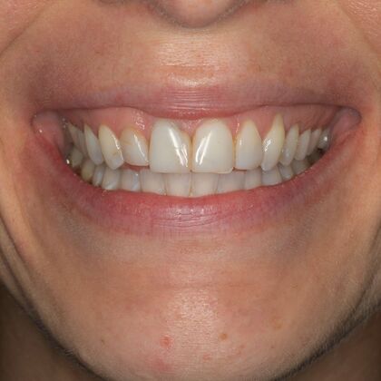 Porcelain Veneers: GJ - Before