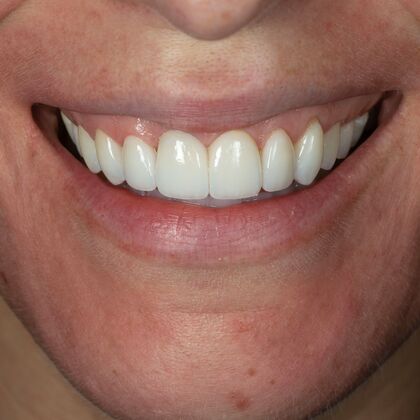 Porcelain Veneers: GJ - After