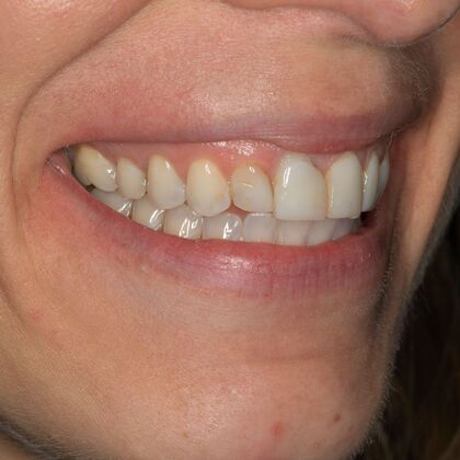 Porcelain Veneers: GJ - Before