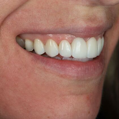 Porcelain Veneers: GJ - After