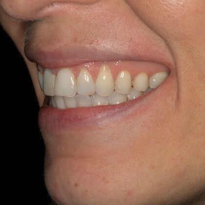 Porcelain Veneers: GJ - Before