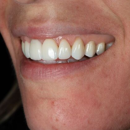 Porcelain Veneers: GJ - After