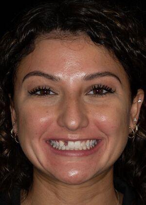 Porcelain Veneers: CH - Before