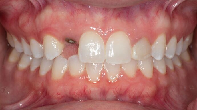 Porcelain Veneers: CH - Before