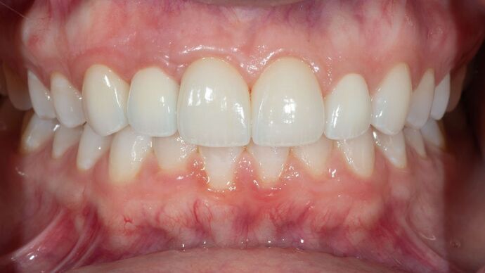 Porcelain Veneers: CH - After