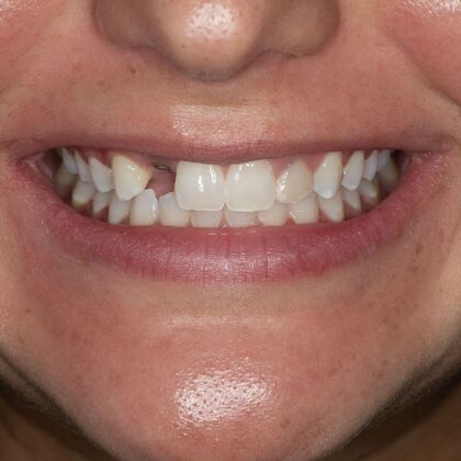 Porcelain Veneers: CH - Before