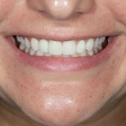 Porcelain Veneers: CH - After