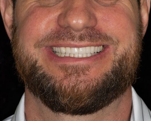 Porcelain bridges: MM - After