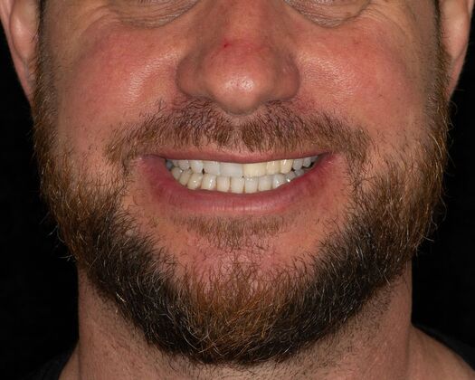 Porcelain bridges: MM - Before