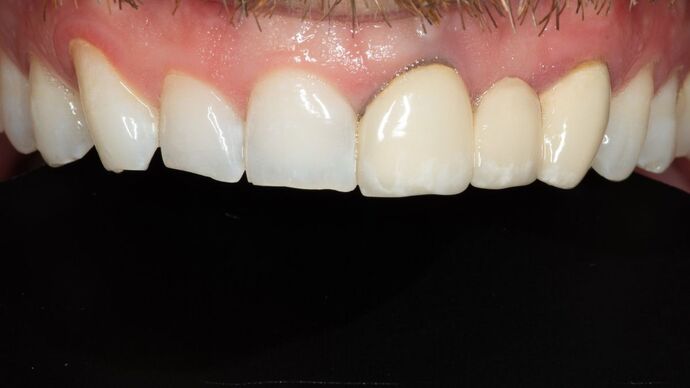 Porcelain bridges: MM - Before