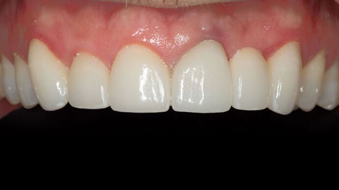 Porcelain bridges: MM - After