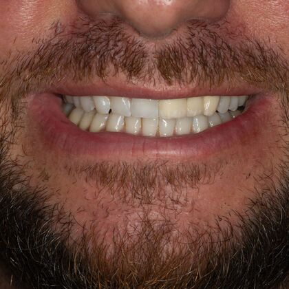 Porcelain bridges: MM - Before