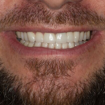 Porcelain bridges: MM - After