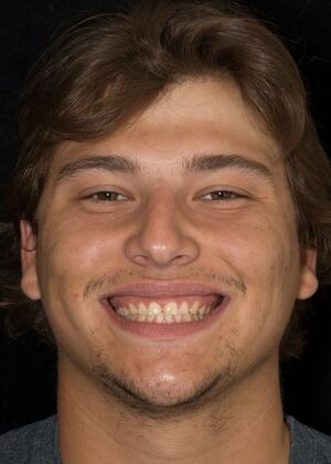 Porcelain Veneers: JG - Before