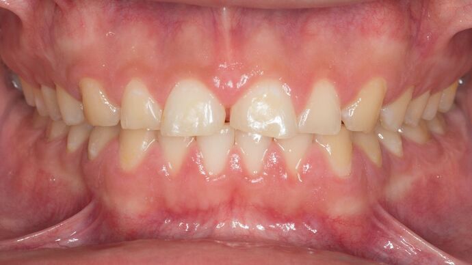 Porcelain Veneers: JG - Before