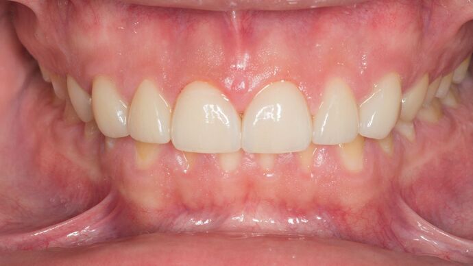 Porcelain Veneers: JG - After