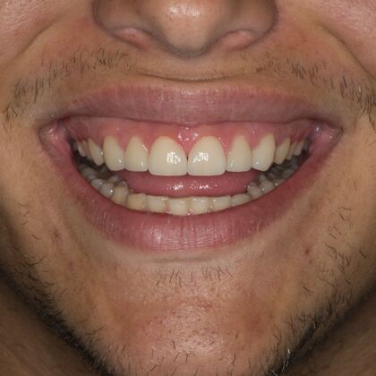 Porcelain Veneers: JG - After