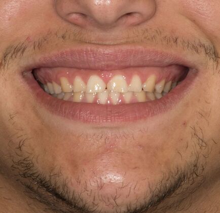 Porcelain Veneers: JG - Before
