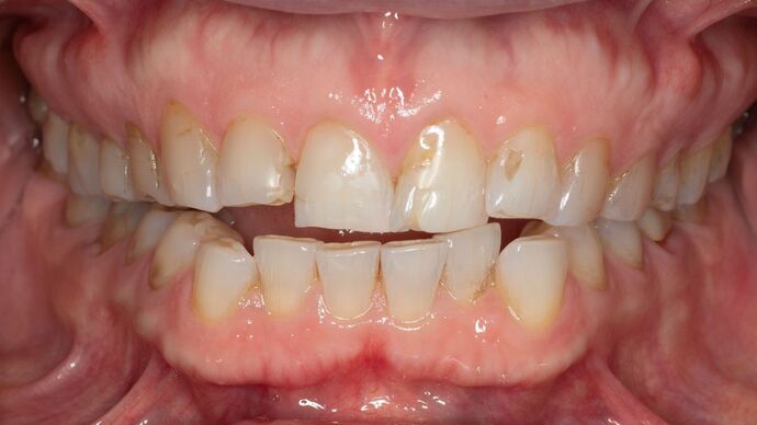 Full Mouth Rehabilitation: GS - Before