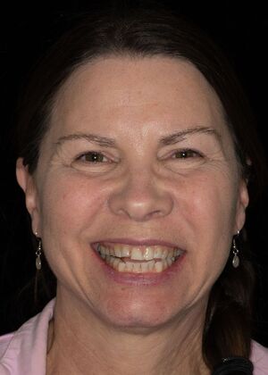 Full Mouth Rehabilitation GS - Before